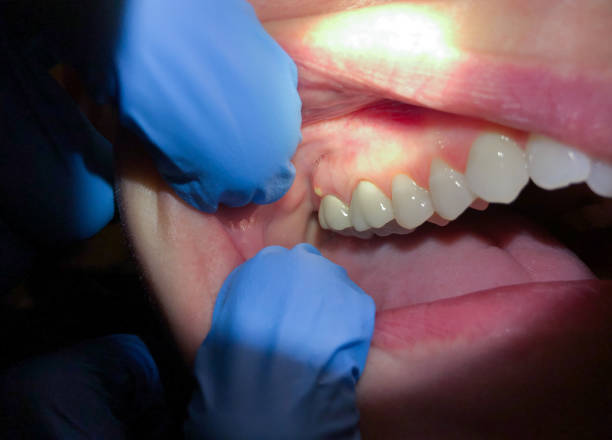 Best Emergency Treatment for Dental Infections or Abscesses in South Haven, MI